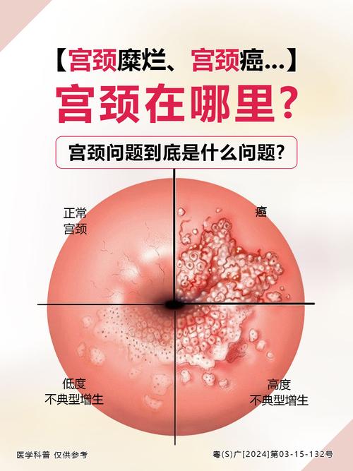 性欲低和宫颈病变有关吗