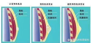 性欲低和男性乳房发育有关吗-两性知识丨两性健康--你想了解的我都知道