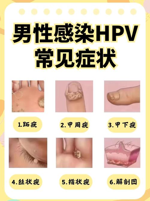 男性HPV感染有哪些表现