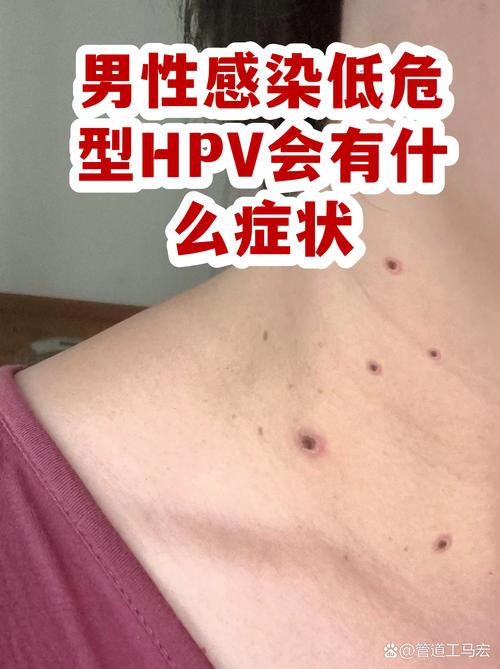 男性HPV感染有哪些表现