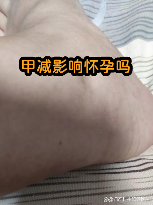 甲减会影响怀孕吗