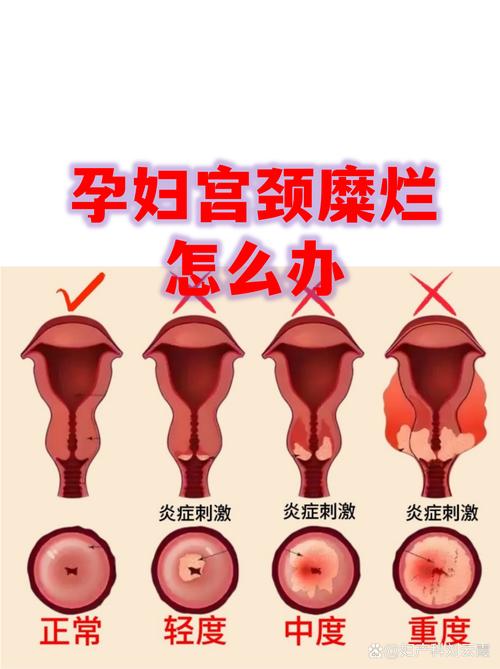 孕期发现宫颈病变怎么处理