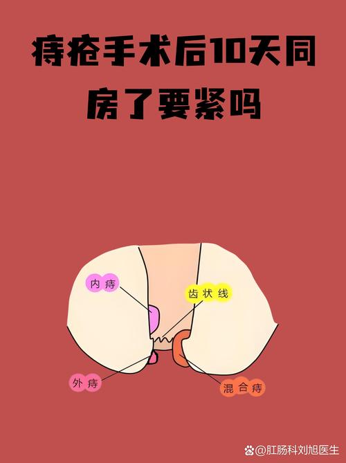 性欲低和痔疮手术后有关吗-相关配图