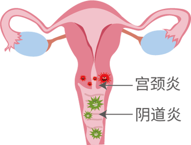 性交疼痛要不要做盆腔检查