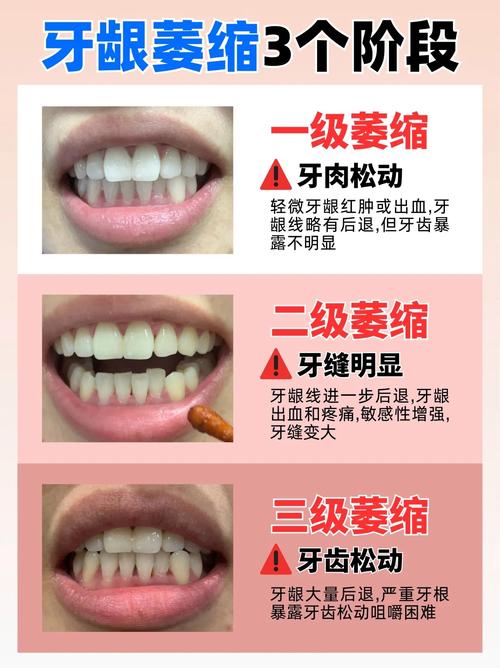 性欲低和牙龈萎缩有关吗-相关配图