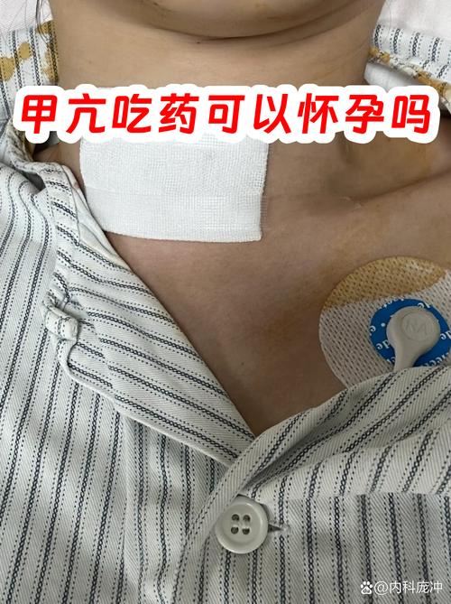甲亢吃药期间能怀孕吗