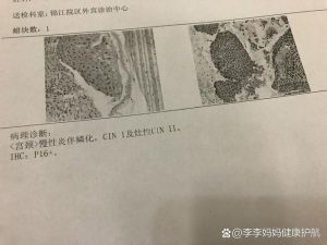 CIN2级的处理方案，这样选更稳妥-两性知识丨两性健康--你想了解的我都知道