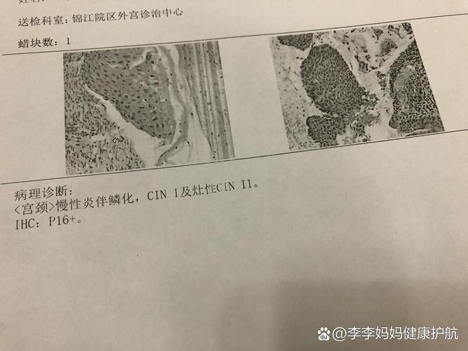 CIN2级该怎么处理更稳妥-相关配图