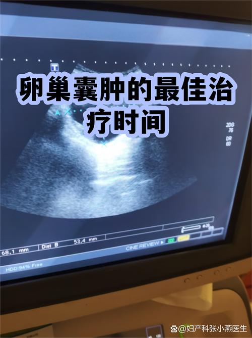卵巢囊肿多大才需要处理-相关配图
