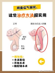 性欲低和疝气手术有关吗-两性知识丨两性健康--你想了解的我都知道