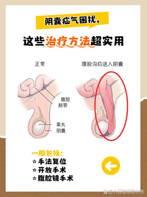 性欲低和疝气手术有关吗